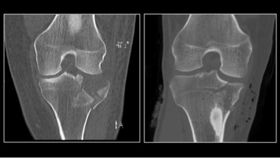 An ultra-low dose CT scan of a fracture of the tibial plateau (left) compared to a conventional dose CT scan