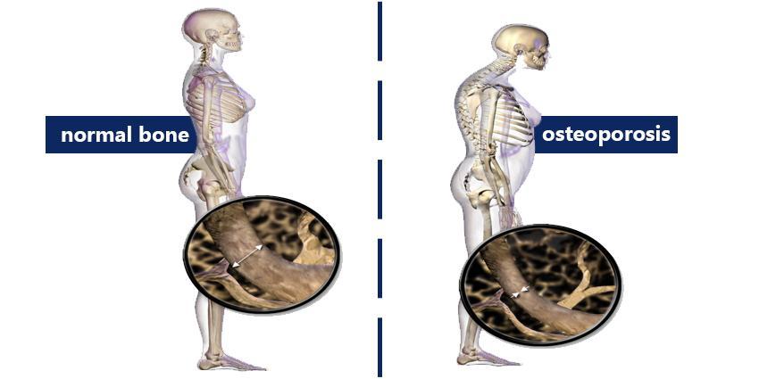 tratamentul osteoporozei coloanei vertebrale genunchi umflați și tratament pentru durere