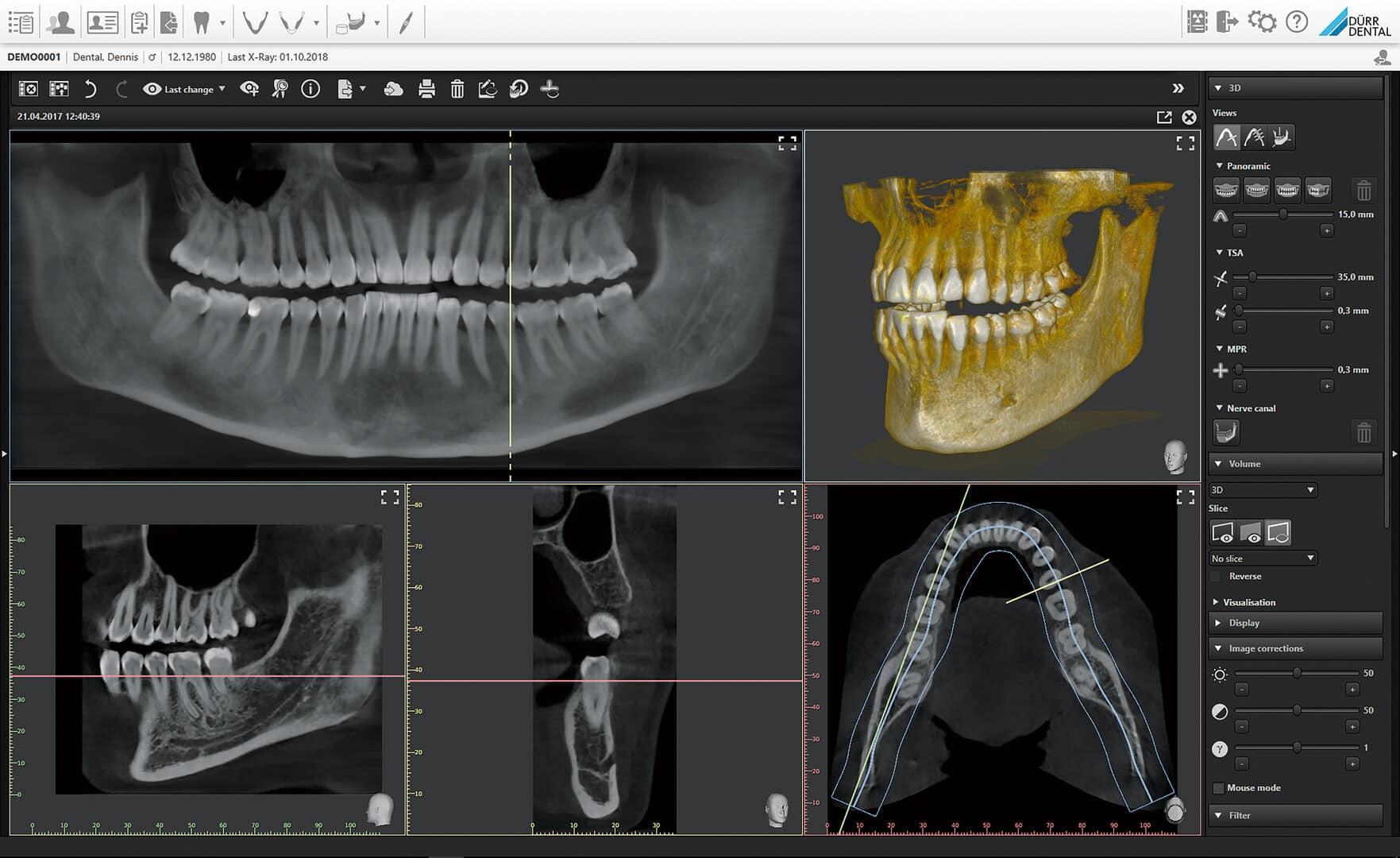 Ray Duerr Sell PANORAMIC X-RAY SYSTEM (Orthopantomograph) DÜRR DENTAL VistaVox S ...
